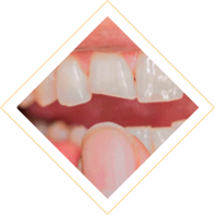 Dentes-danificados.png
